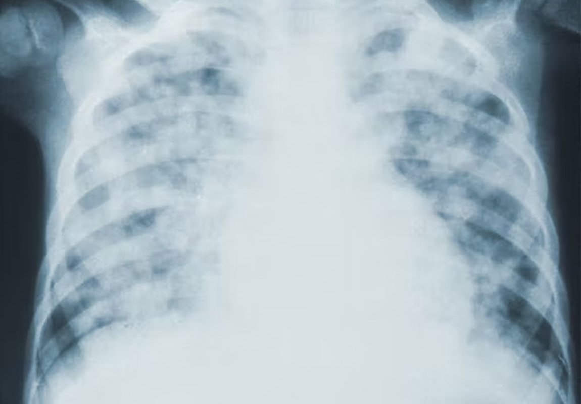 рентген грудной клетки