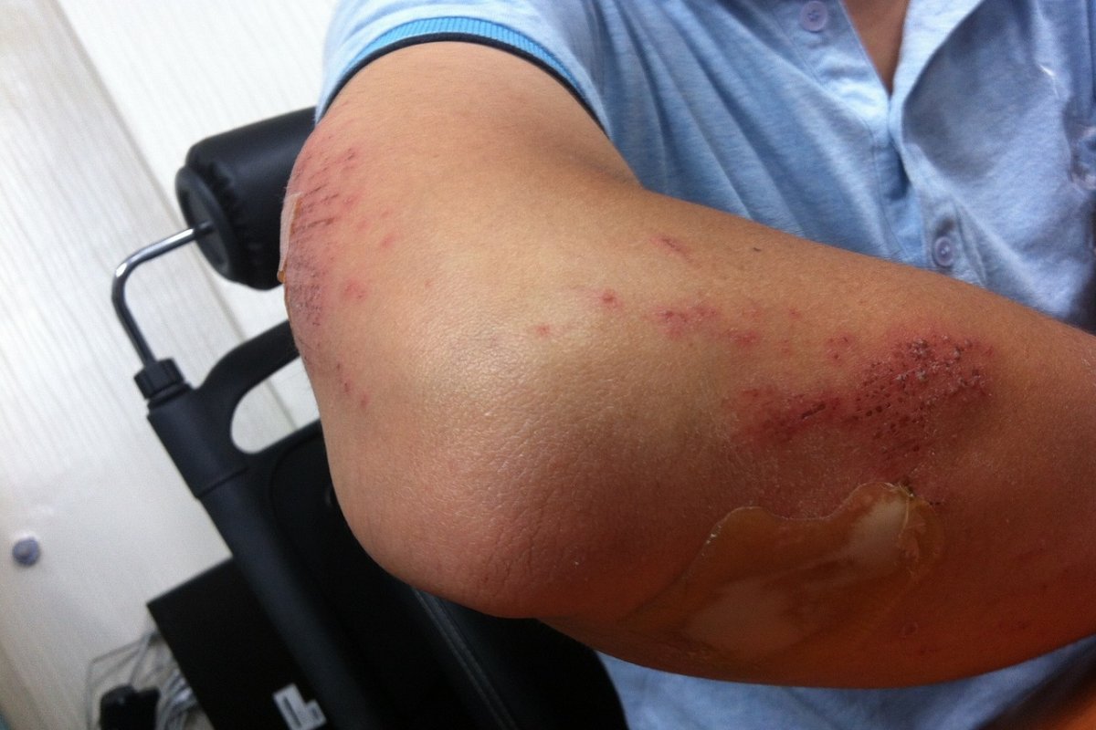 Возникновение необъяснимых синяков говорит об опасном дефиците трех витаминов