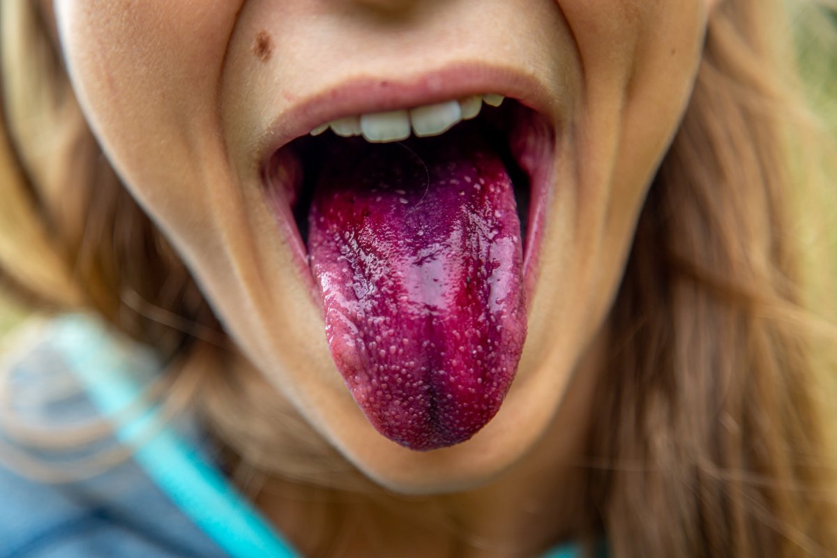 "Мошоночный язык" сигнализирует о дефиците витаминов — язык «сморщенный, бороздчатый»