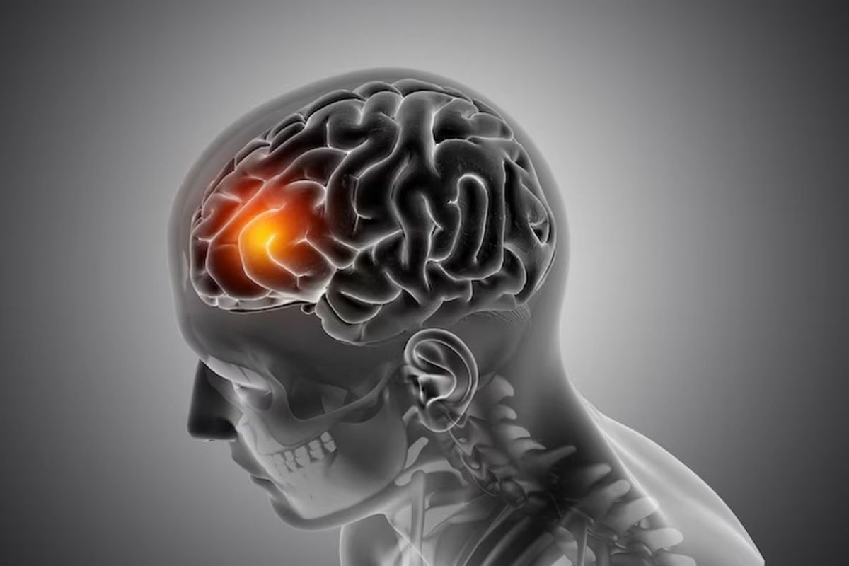 Пять «тихих» симптомов инсульта могут быть более разрушительными для мозга