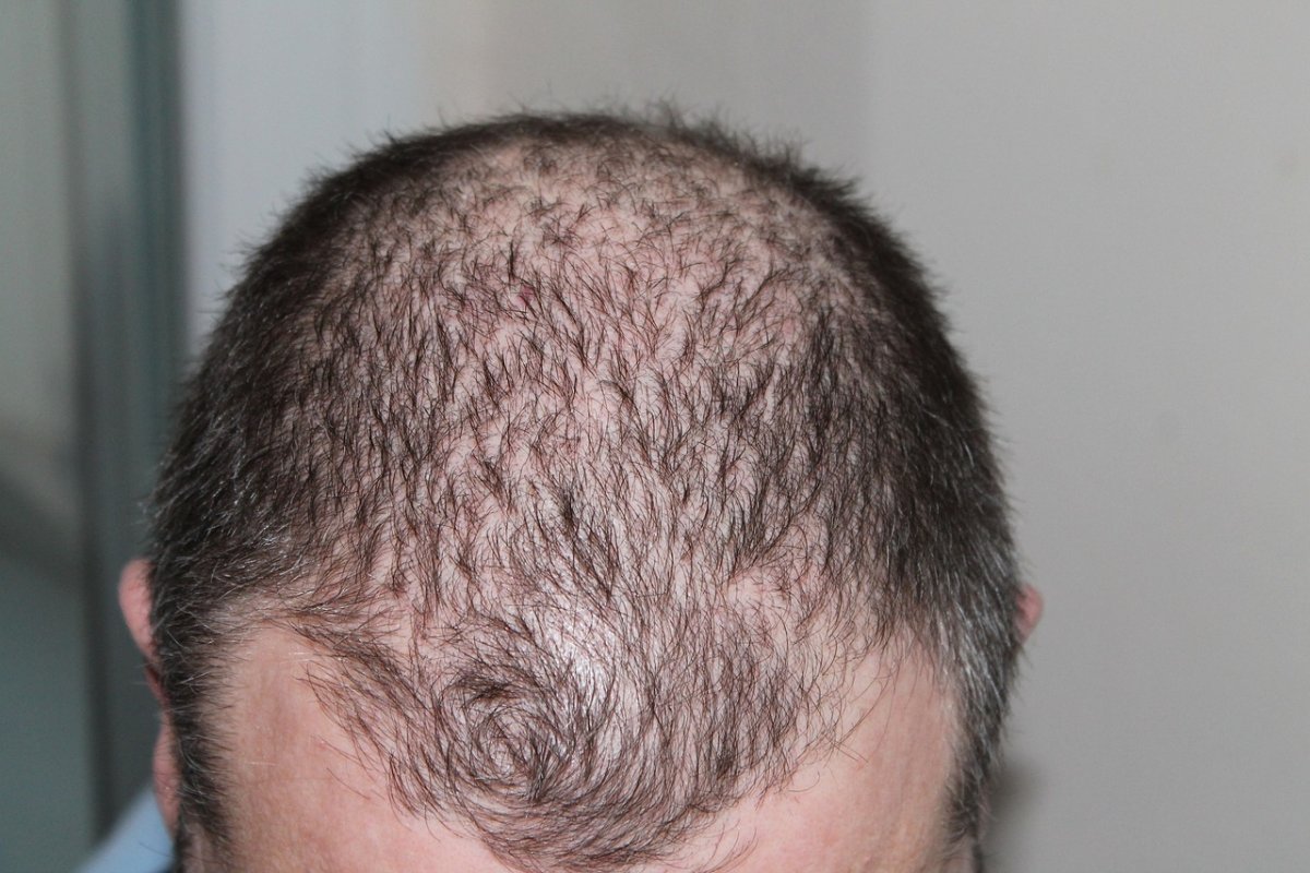 Трихолог Спиридонов: найдено средство, которое останавливает выпадение волос