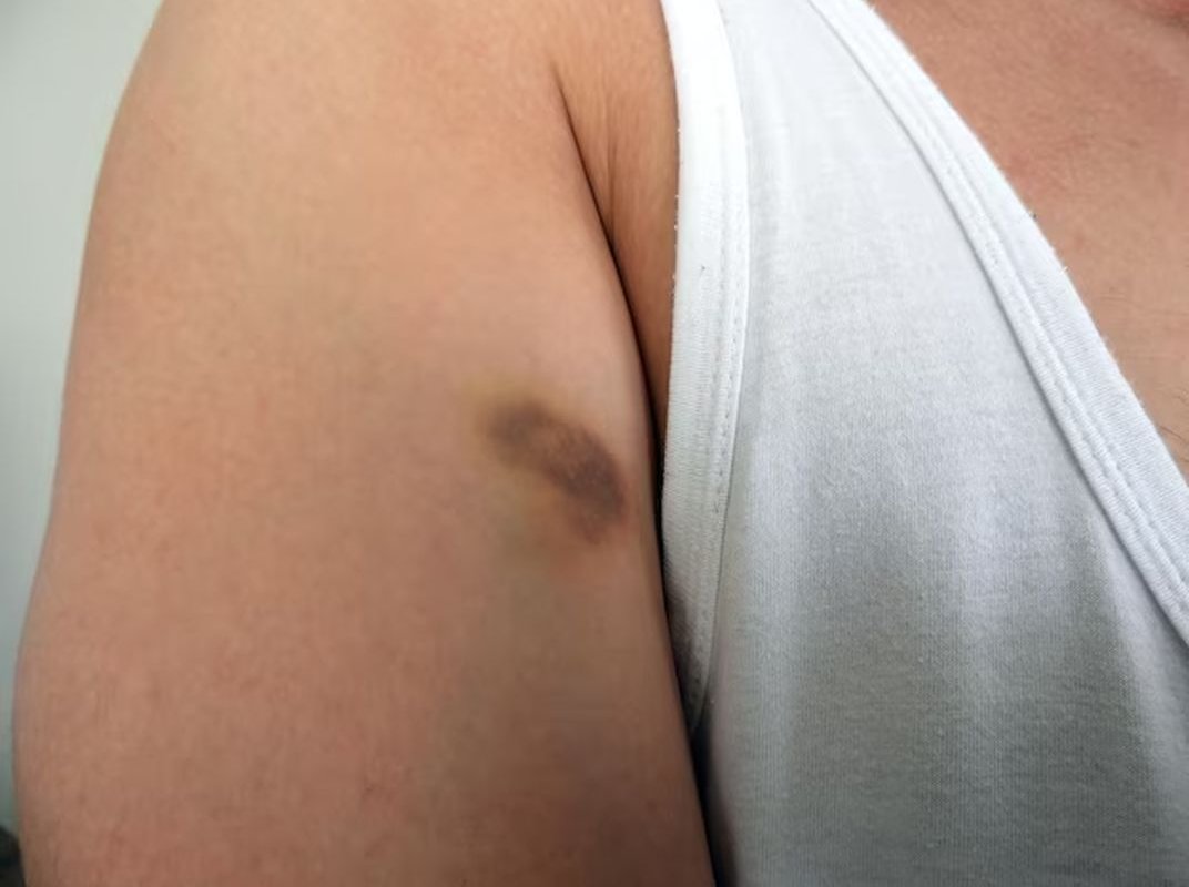 синяк на руке